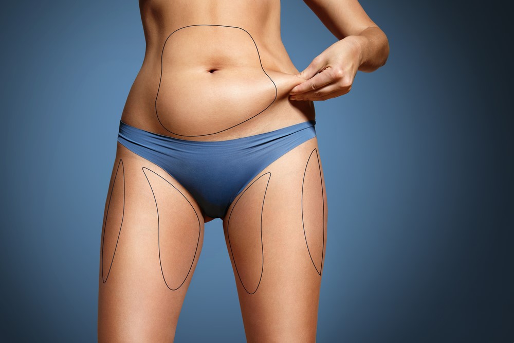 Liposuction recovery