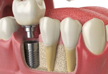 Facts to know about dental implants