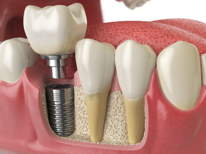 Facts to know about dental implants