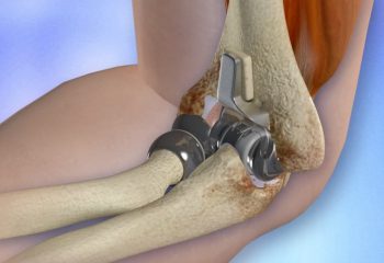 Elbow replacement surgery