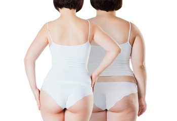 Bariatric surgery vs Liposuction