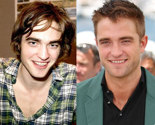 Male celebrity nose job before and after - Robert Pattinson
