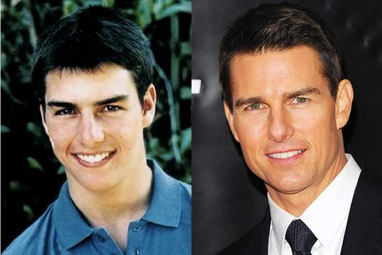 Male celebrity nose job before after