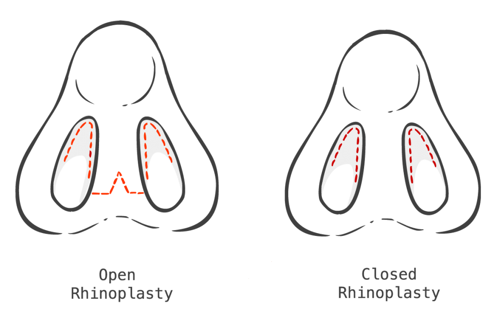 Closed vs Open Rhinoplasty