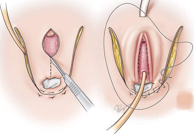 sex reassignment surgery