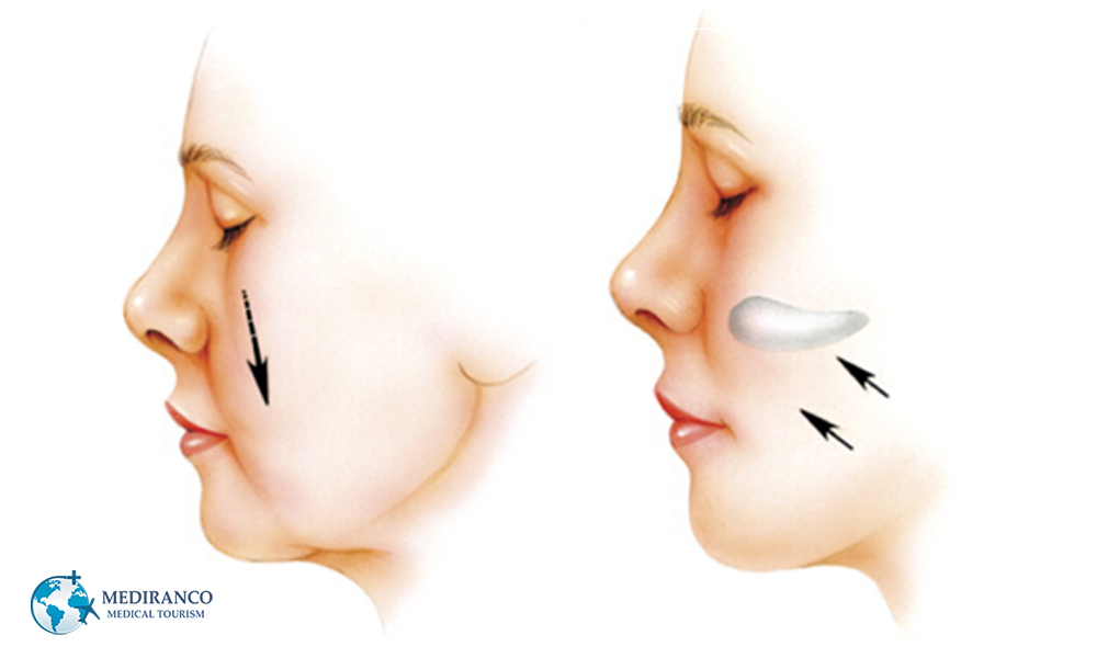 cheek augmentation before