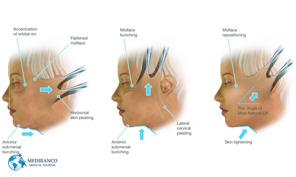 surgical facelift