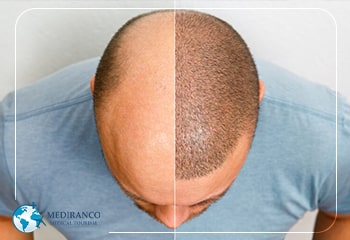 hair transplantation method