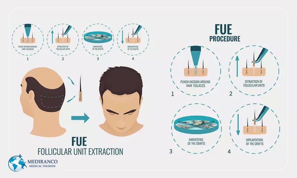SuperFUE is one of the types of hair transplant