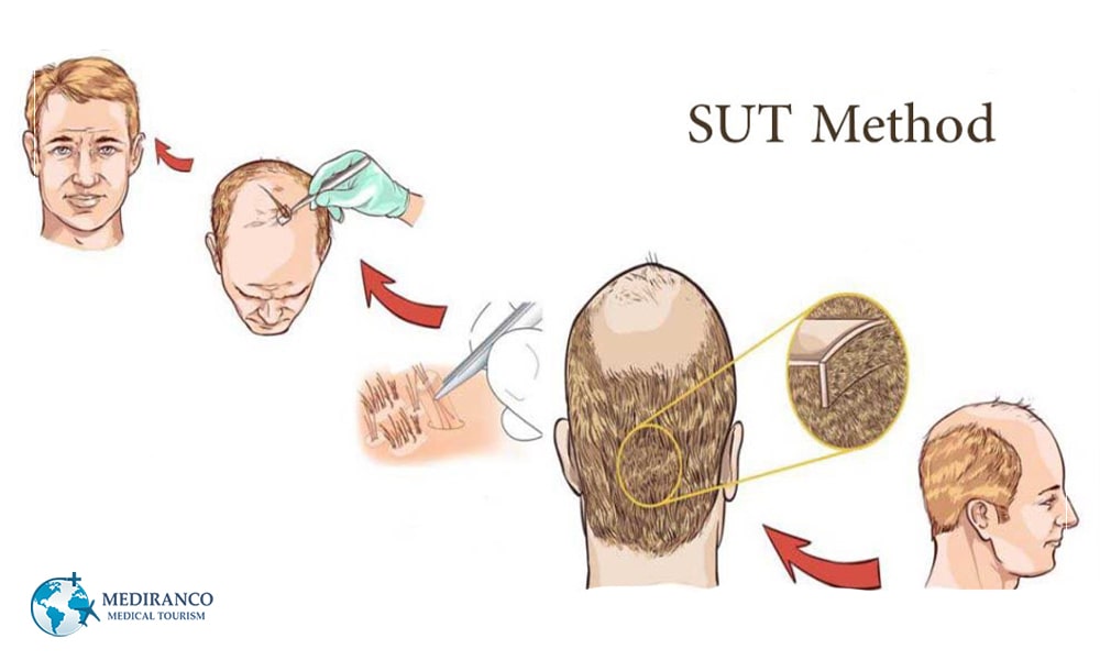 SUT technique is one of the hair transplantation method