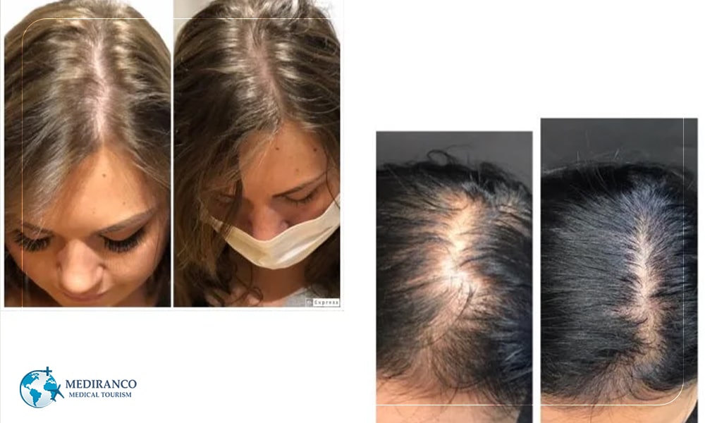 HRT technique one of types of hair transplant