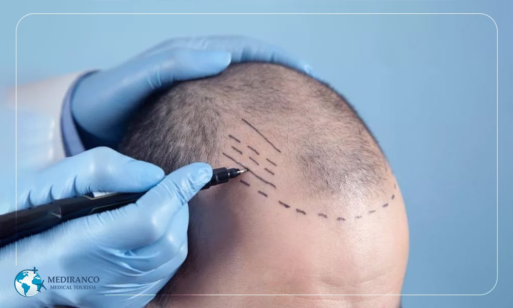 hair transplantation method