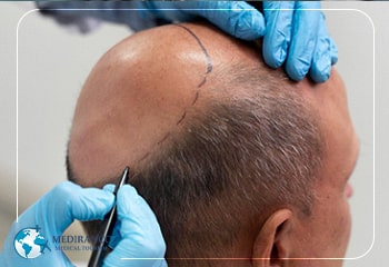 Hair Transplant using body hair