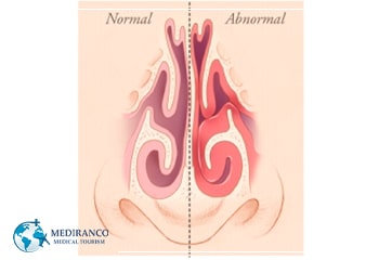 Can Rhinoplasty Fix Sinus