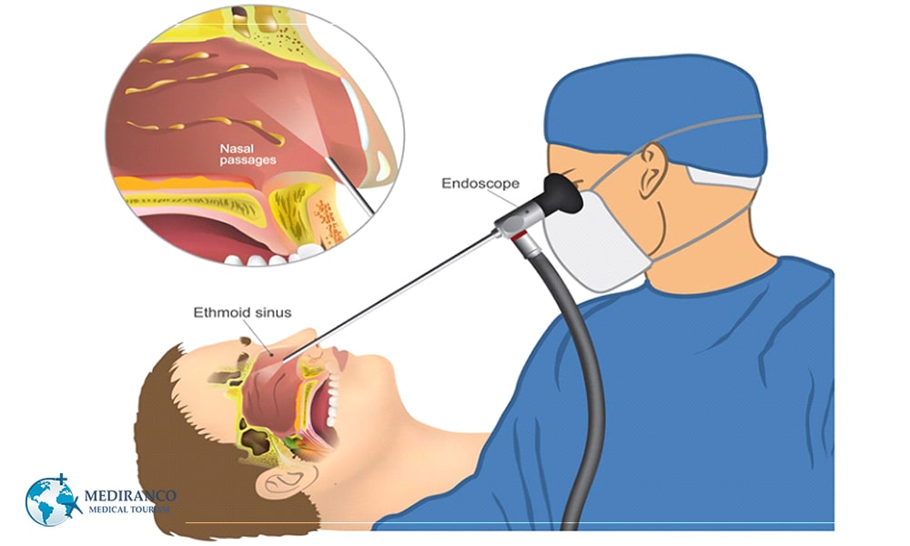 Can Rhinoplasty Fix Sinus