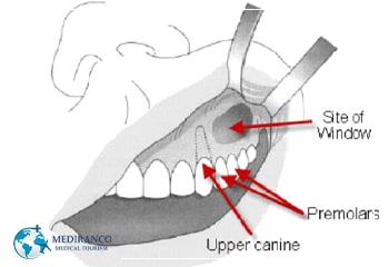 Can Rhinoplasty Fix Sinus