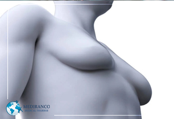 causes of gynecomastia What causes gynecomastia Mediranco