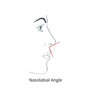 Nasolabial (Alar Facial Angle)