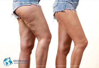 Who is a good candidate for thigh lift?