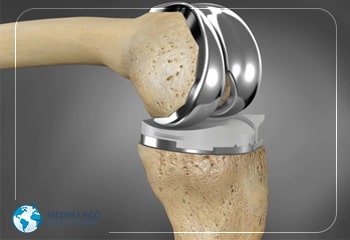 3D printed knee replacement