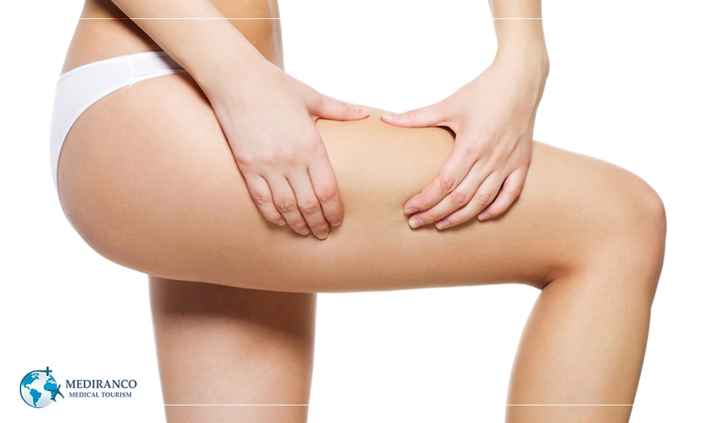 Who is a good candidate for thigh lift?