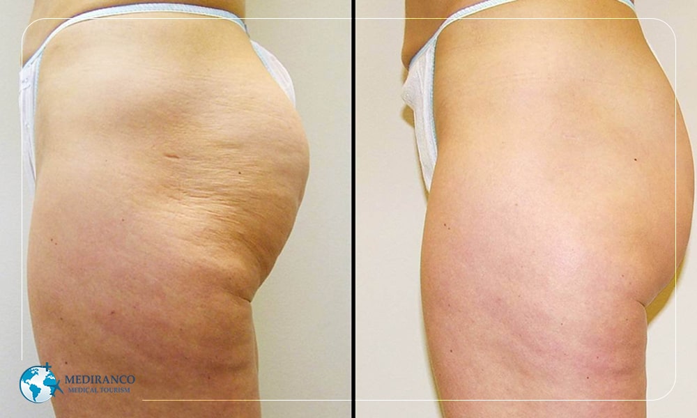 Non surgical cellulite reduction 