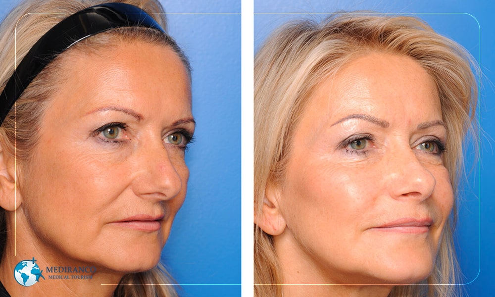 Facelift Myths Debunked