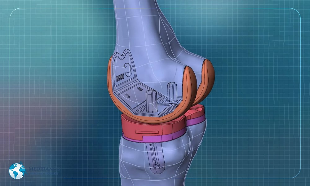 3D printed knee replacement