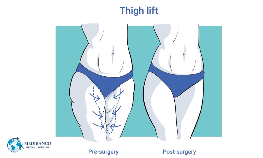Who is a good candidate for thigh lift?