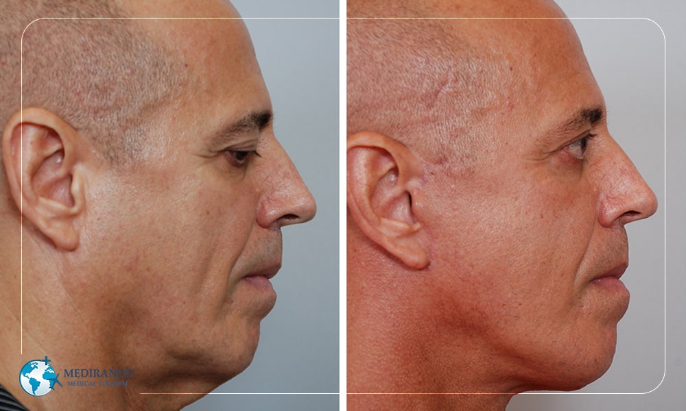 Facelift Myths Debunked