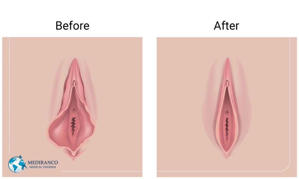 labia majora augmentation