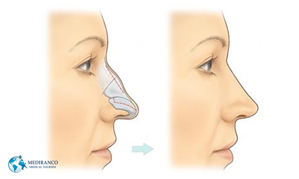 Rhinoplasty in the Older Adults