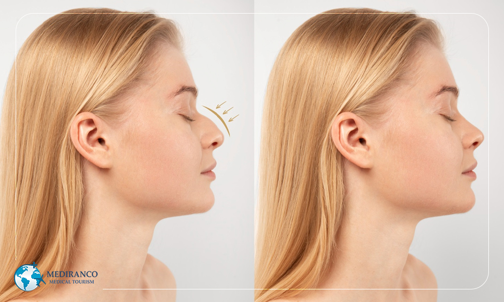 Can rhinoplasty help with allergies?