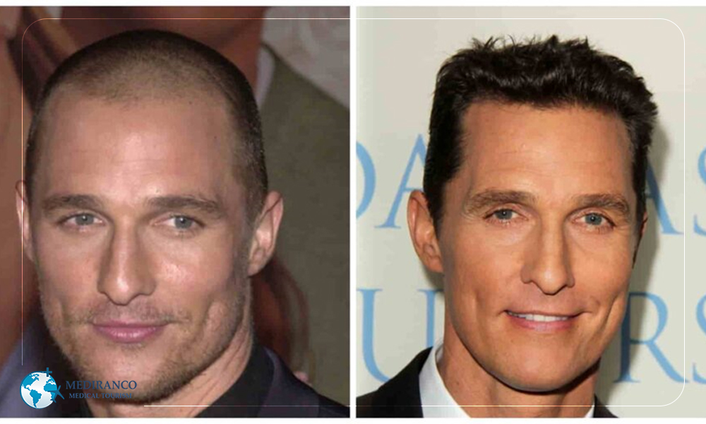 where do celebrities get hair transplants