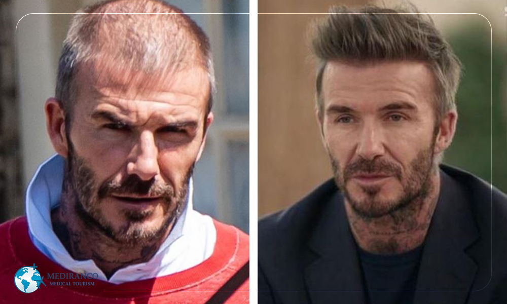 David Beckham - celebrity hair transplant