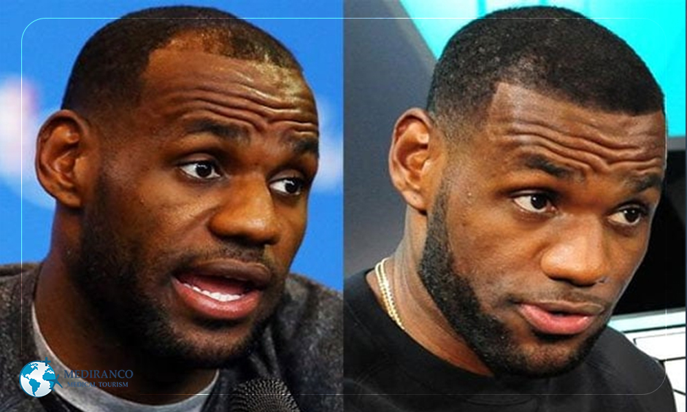 Black celebrity hair transplants before and after photos