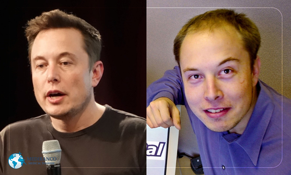 Elon Musk - celebrity hair transplants