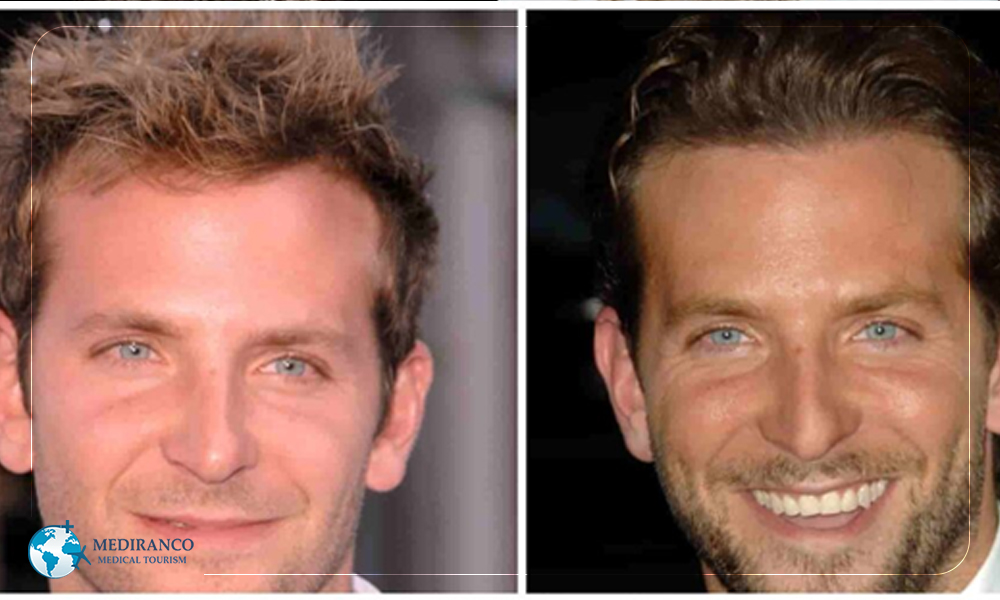  Bradley Cooper- celebrity hair transplants