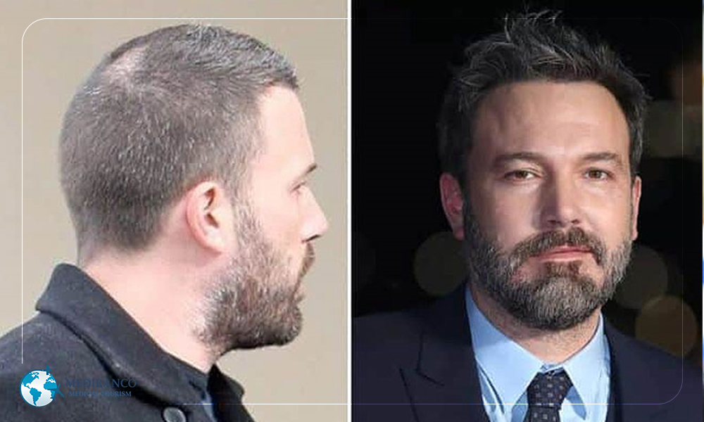 Male celebrity hair transplants before and after photos