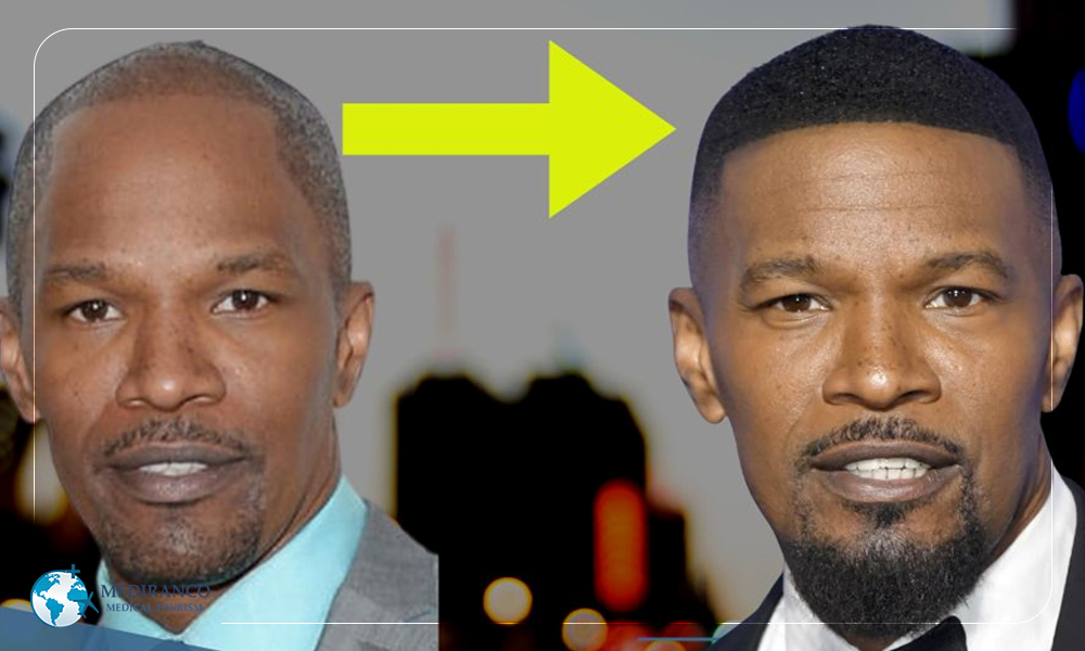 Black celebrity hair transplants before and after photos