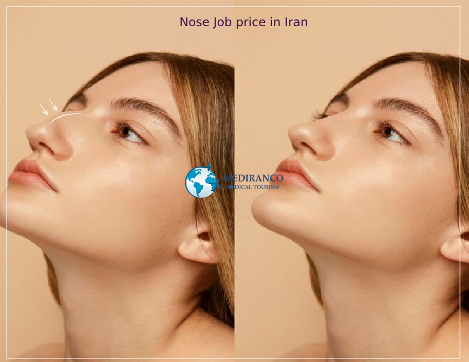 Nose Job price in Iran